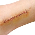Infected Stitches Pictures You Must See: Early to Severe Stages