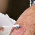 Iodoform Packing: How to Use It the Right Way