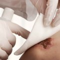Identify Granulation Tissue vs Slough in Wound Healing