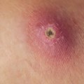 Boil vs Cyst vs Abscess: Key Signs and When to Act Fast