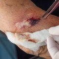 Serosanguineous Drainage Guide: Causes, Color, and Care Tips