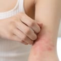 Is Itching a Sign of Healing? Here’s What Your Body Might Be Trying to Tell You During Recovery
