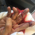 How to Treat a Skin Avulsion Wound on Finger Safely at Home