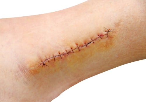 Infected Stitches Pictures You Must See: Early to Severe Stages
