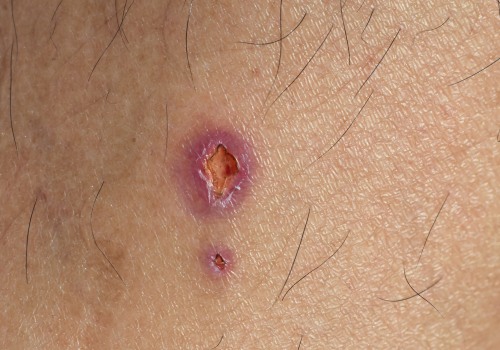 Granulation Tissue Wound Pictures That Highlight Recovery, Complications & Care