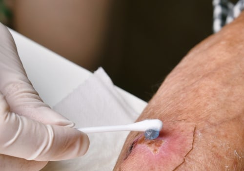Iodoform Packing: How to Use It the Right Way