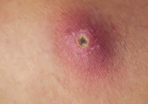 Boil vs Cyst vs Abscess: Key Signs and When to Act Fast