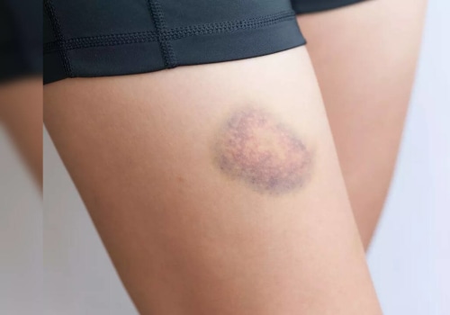 Does a Blood Clot Look Like a Bruise? Know the Risks, Clues, and When It’s More Than Skin Deep