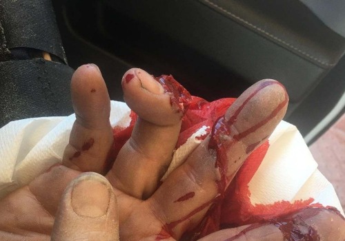 How to Treat a Skin Avulsion Wound on Finger Safely at Home